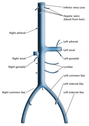 Inferior Vena Cava Syndrome - Modernheal.com