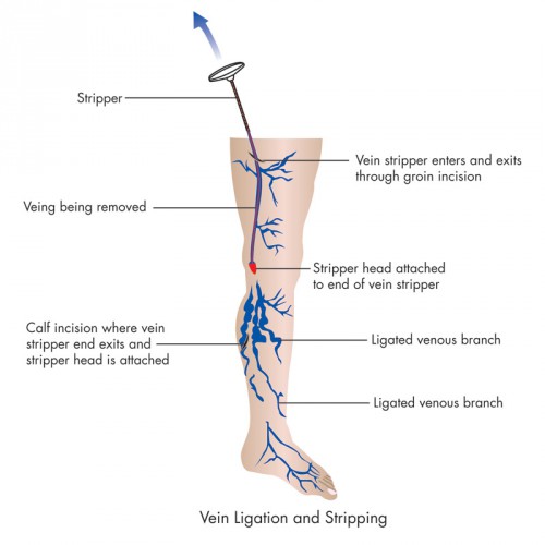 great-saphenous-vein-and-femoral-vein-modernheal